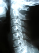 Many automobile insurance policies cover acupuncture for treatment of soft tissue injury following a motor vehicle accident.  